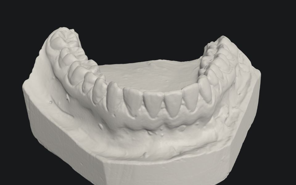 3D-scanning af en underkæbe